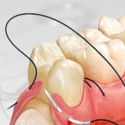 Dental Sutures Market Size Estimated to Grow by USD 102.95 Million by 2027